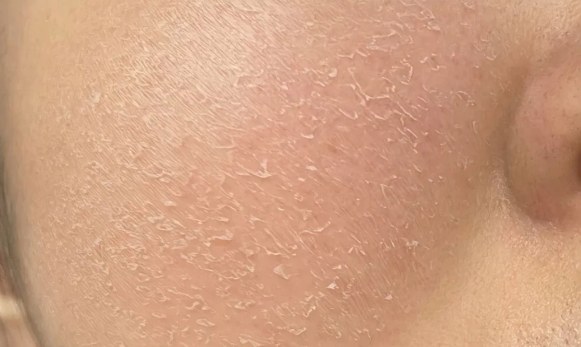 冬天皮肤干红起皮怎么办?