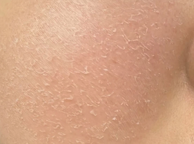 冬天皮肤干红起皮怎么办？